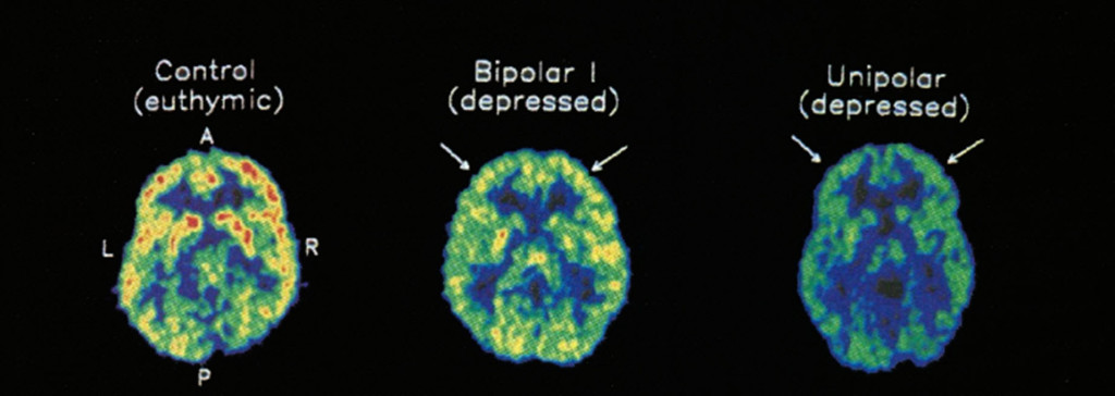 "PET scan taken of a healthy person (control), a bipolar depressed patient (incl phases of mania) and a depressed patient during performance tasks. Red/yellow areas show increased brain activity through measurement of glucose uptake. Source: Ketter et al (2)." From: Christine Webber