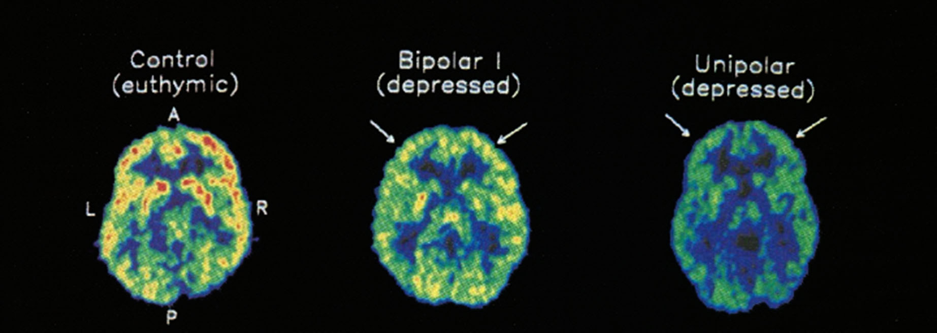 "PET scan taken of a healthy person (control), a bipolar depressed patient (incl phases of mania) and a depressed patient during performance tasks. Red/yellow areas show increased brain activity through measurement of glucose uptake. Source: Ketter et al (2)." From: Christine Webber